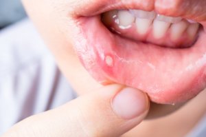 Mouth Ulcer Lip