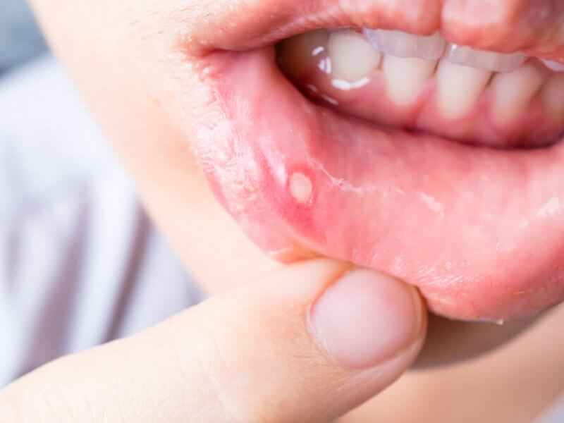 Mouth Ulcer Lip