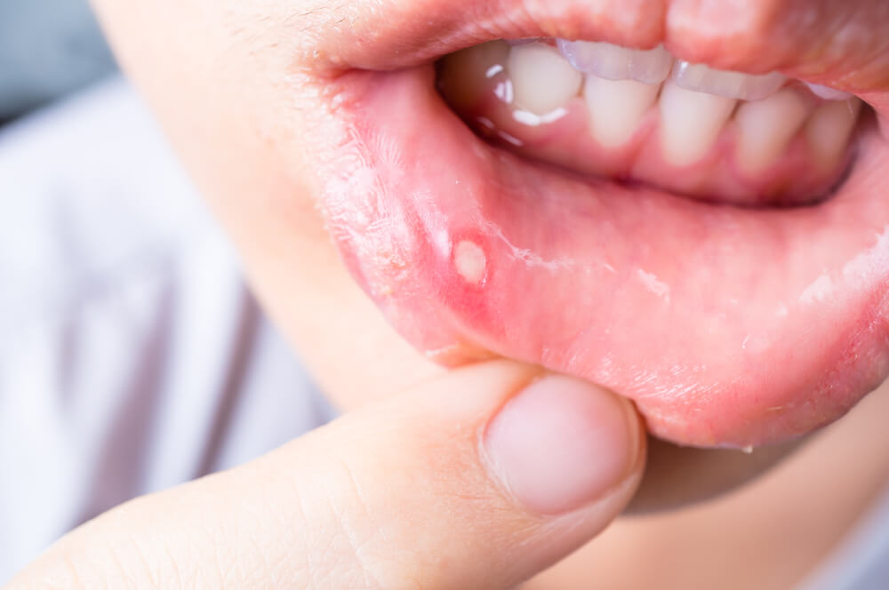 Should I worry about mouth ulcers? - Redmires Dental Care Website