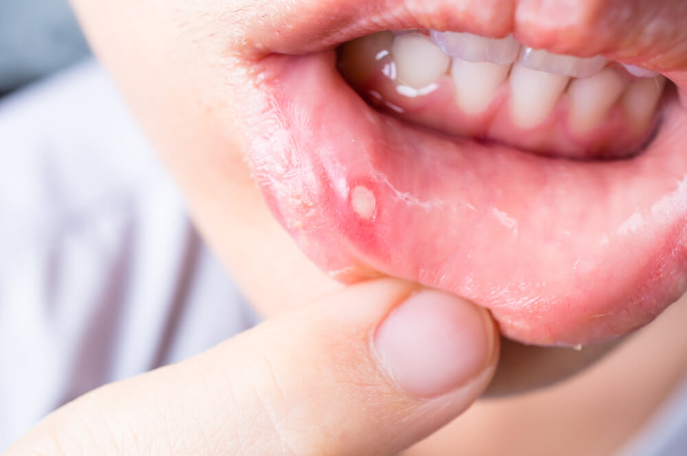 Mouth ulcers