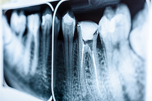 Endodontic X-ray Endodontic X-ray