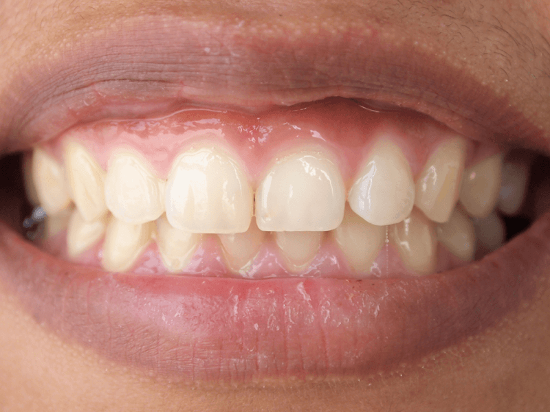 How do I know if I have gum disease?