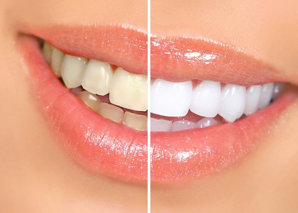 teeth whitening dentist sheffield teeth whitening dentist sheffield