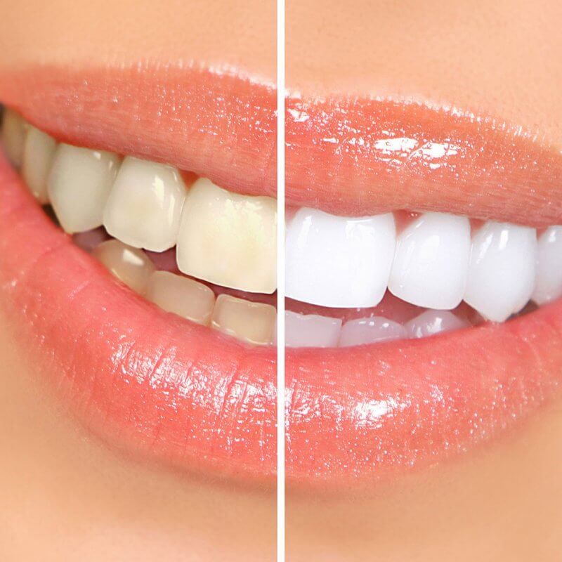 teeth whitening dentist sheffield