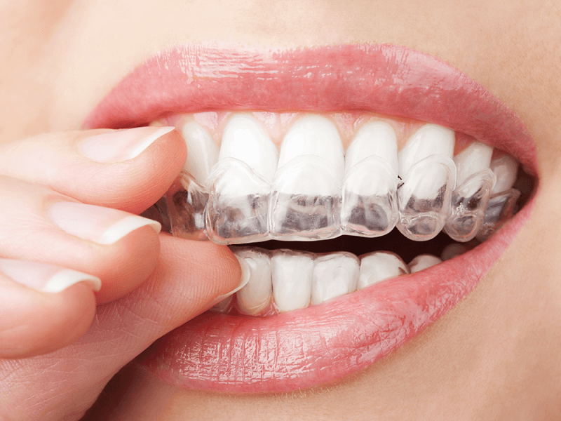 Teeth Whitening Tray